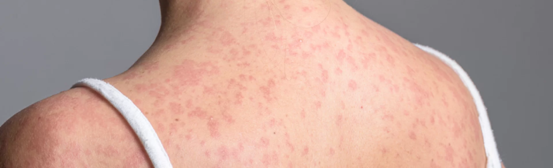 Measles spots