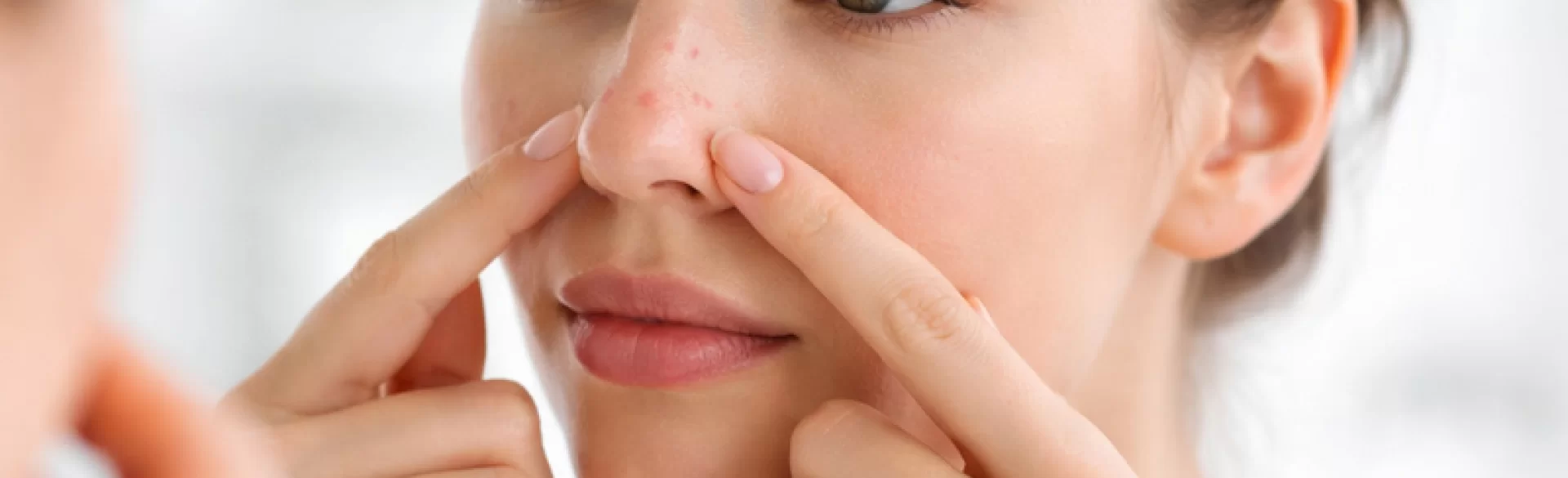 Pimples near the nose