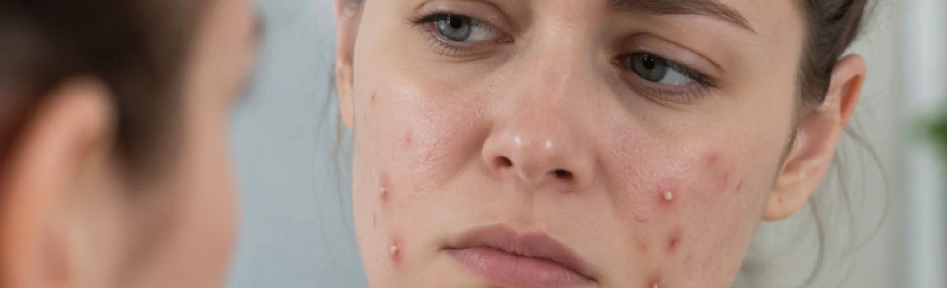 Pustules on the face