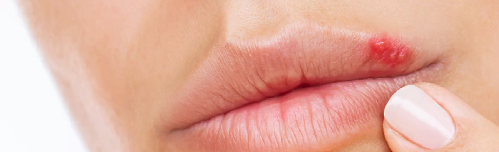 Pimples in the mouth