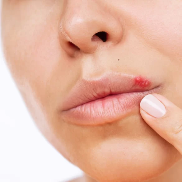 Pimples in the mouth