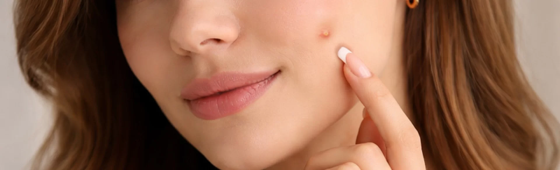 White-headed pimples