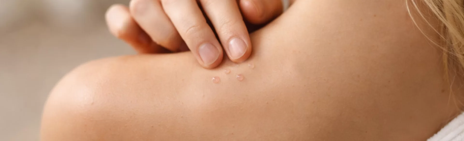 Blisters with serous fluid