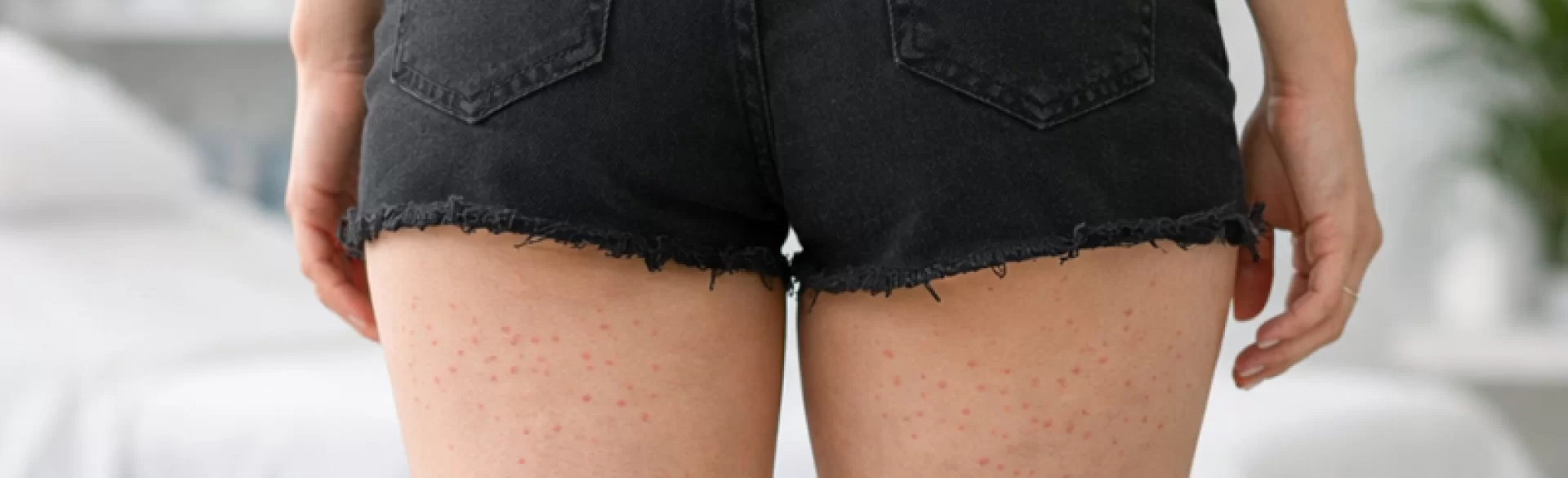 Pimples on the back of the thighs