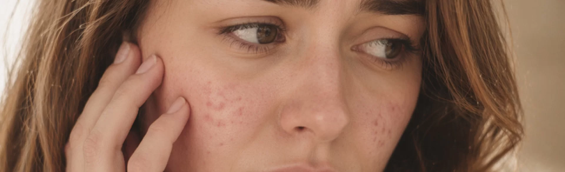 Cold-induced bumps on the face