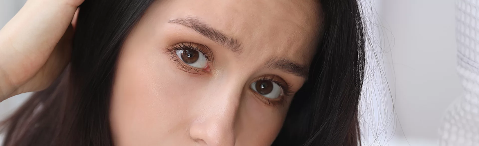 Seborrheic dermatitis