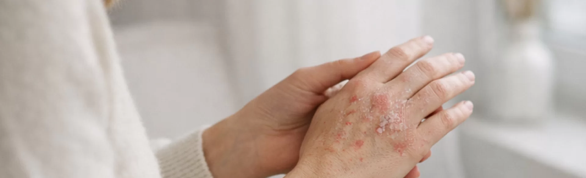 Psoriasis of the hands