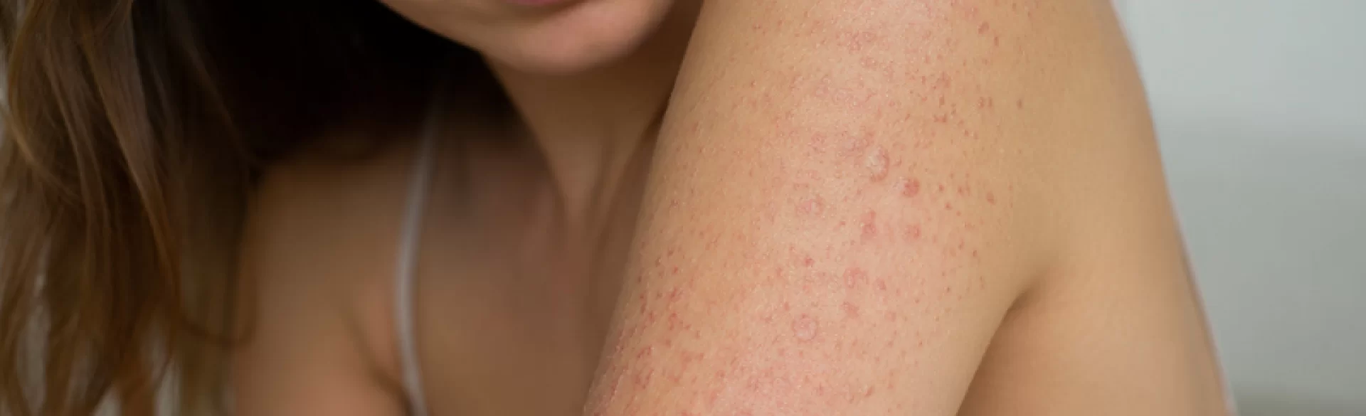 Guttate psoriasis