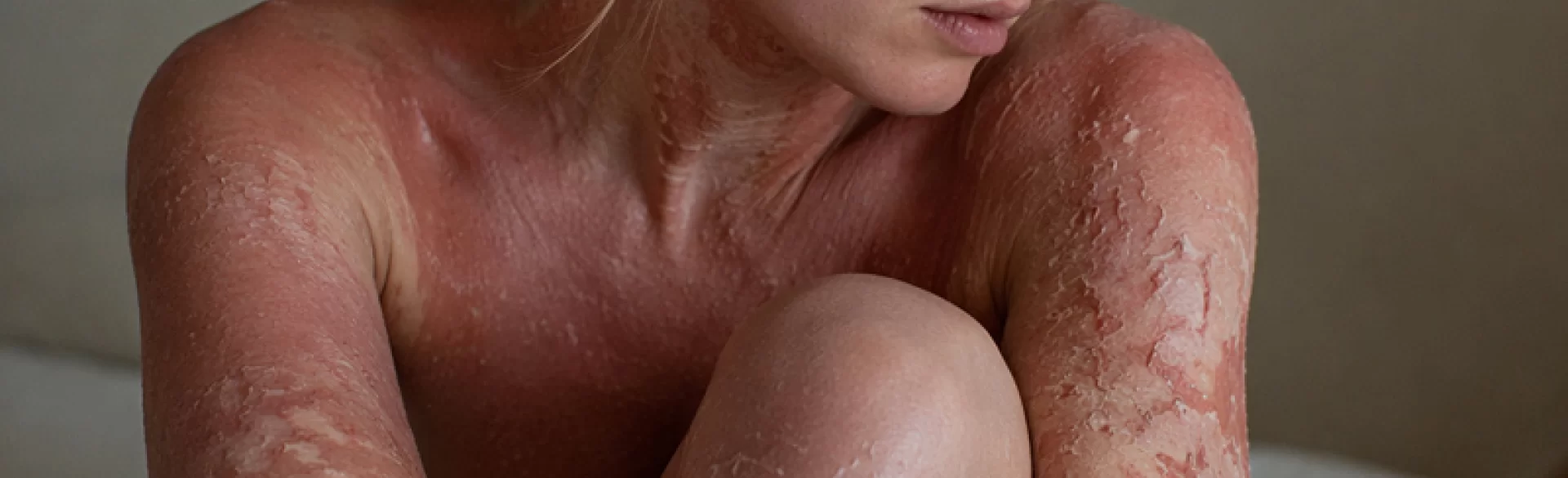 Erythrodermic psoriasis