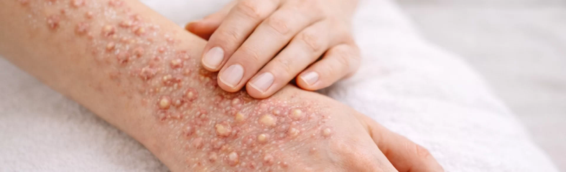 Pustular psoriasis