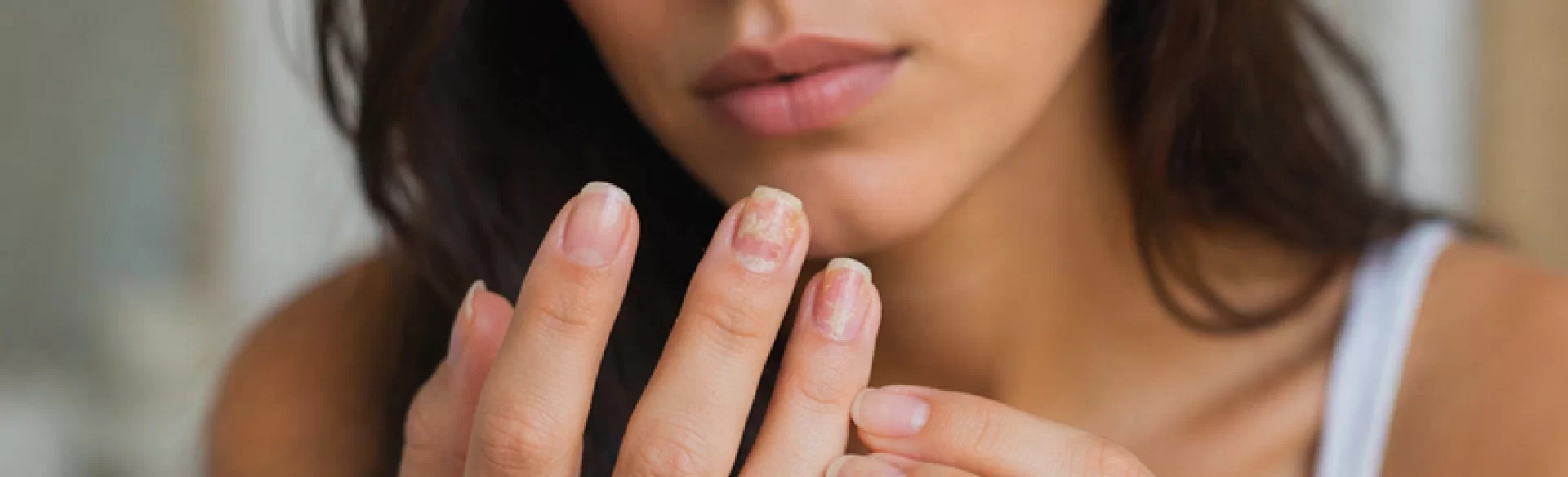 Nail psoriasis