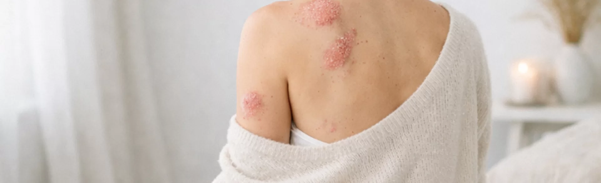 Plaque psoriasis