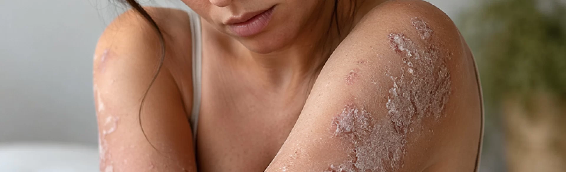 Inveterate psoriasis