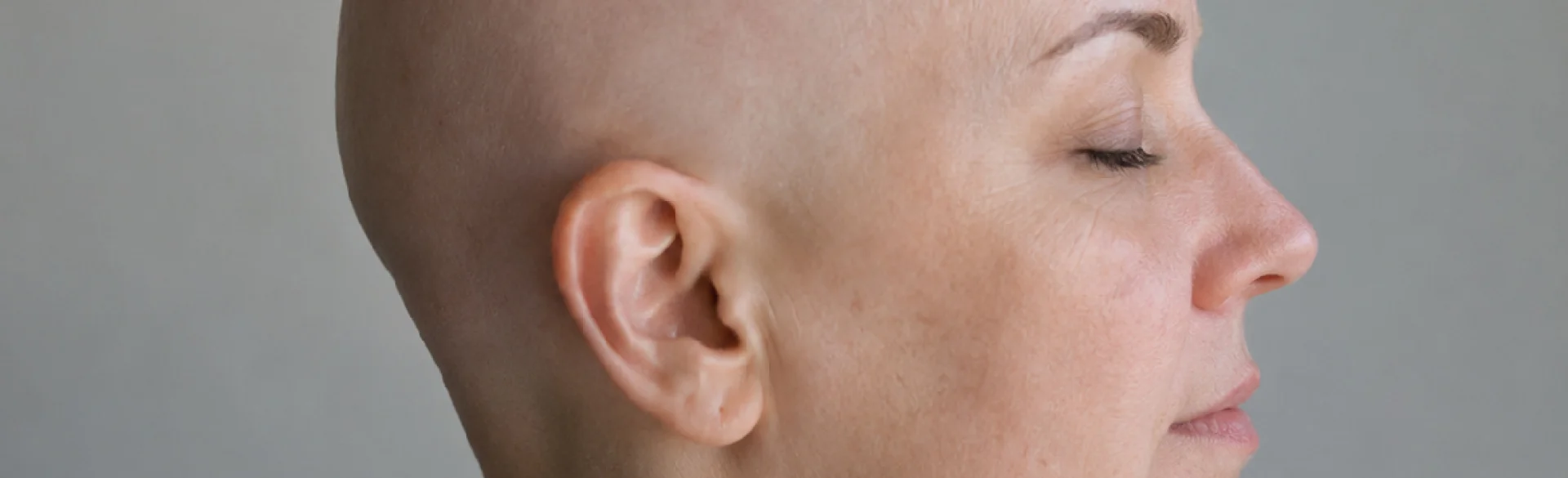 Alopecia totalis