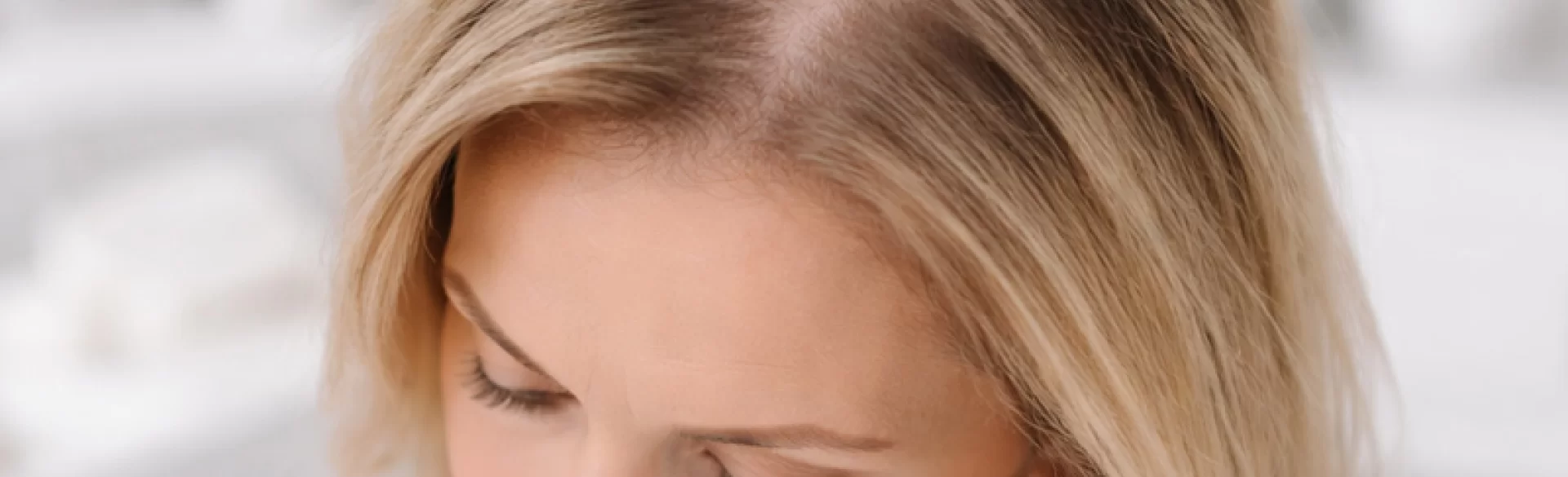 Baldness on the crown of the head