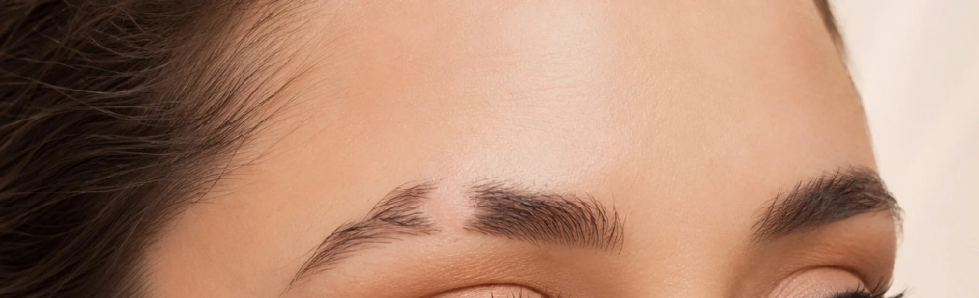 Alopecia areata of the eyebrows