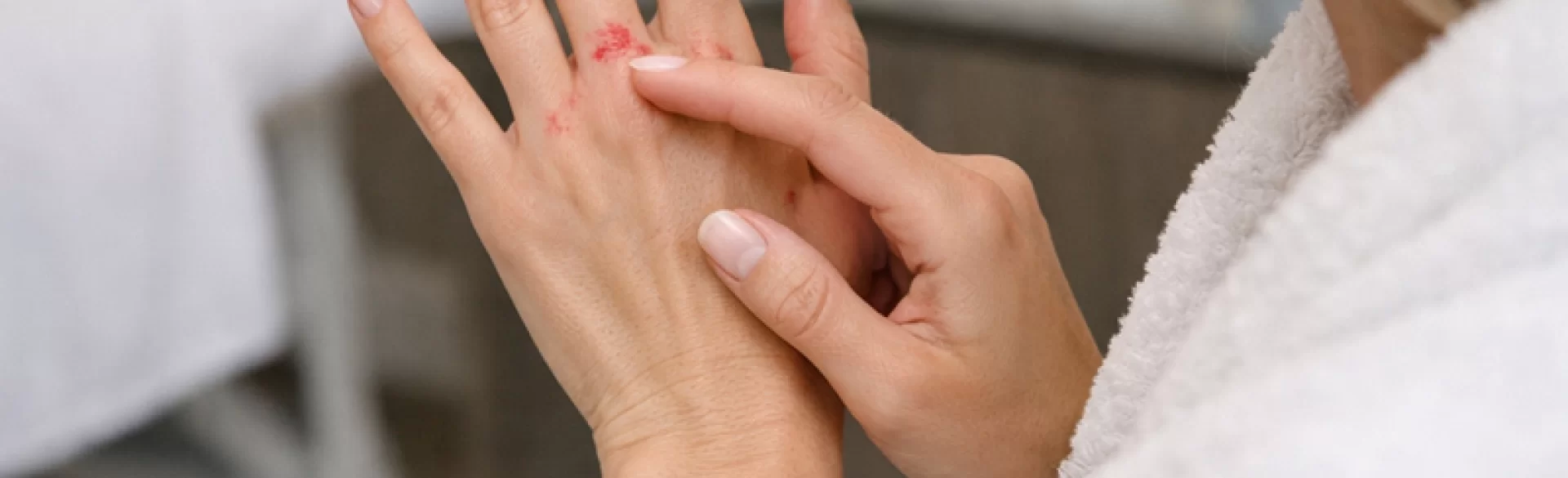 Pimples between the fingers on the hands