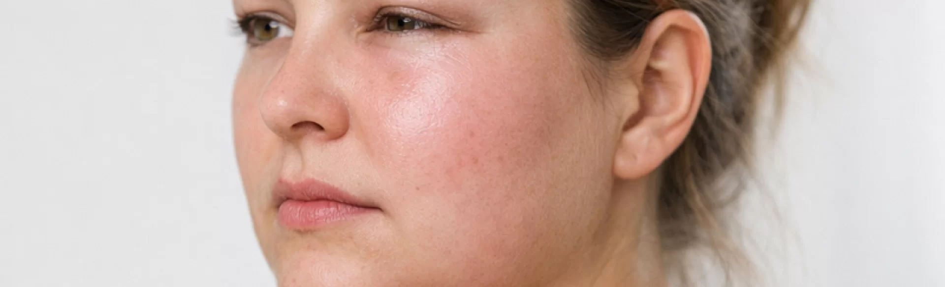 Sudden swelling of the face