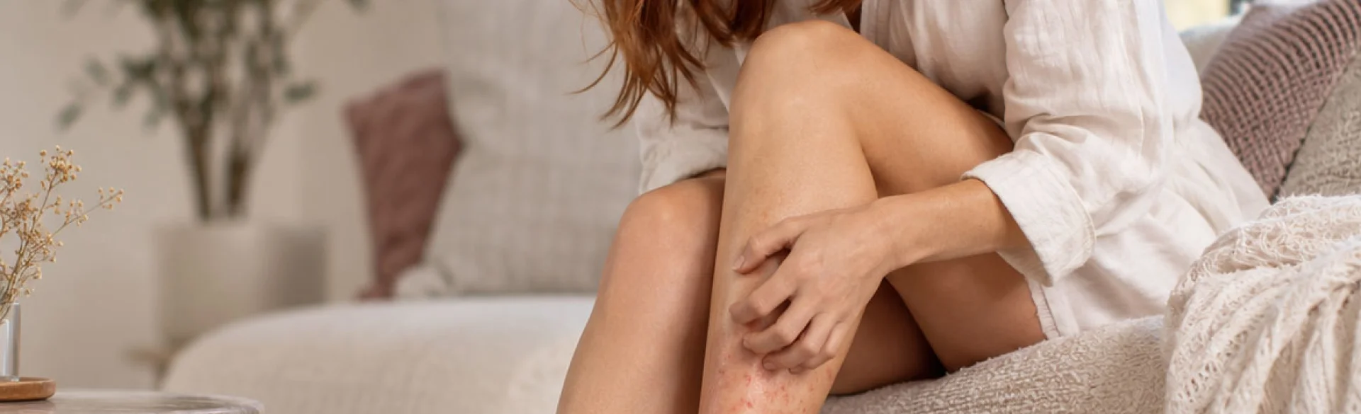 Melasma