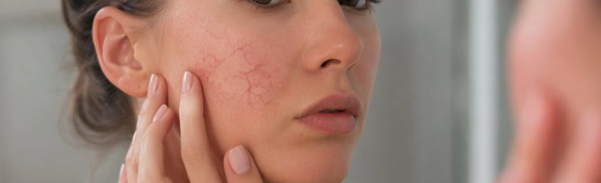Spider veins on the face