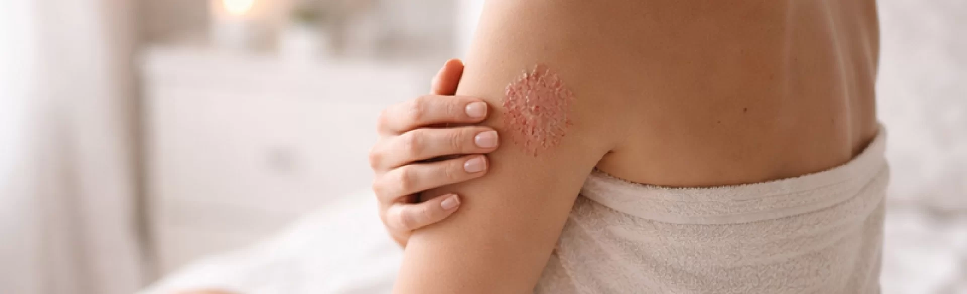 Psoriatic plaques