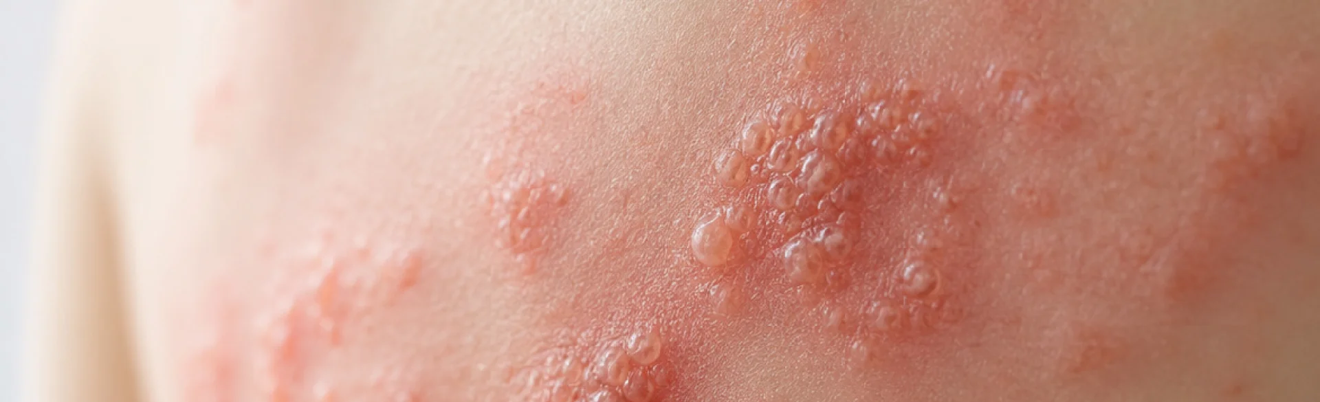 Shingles