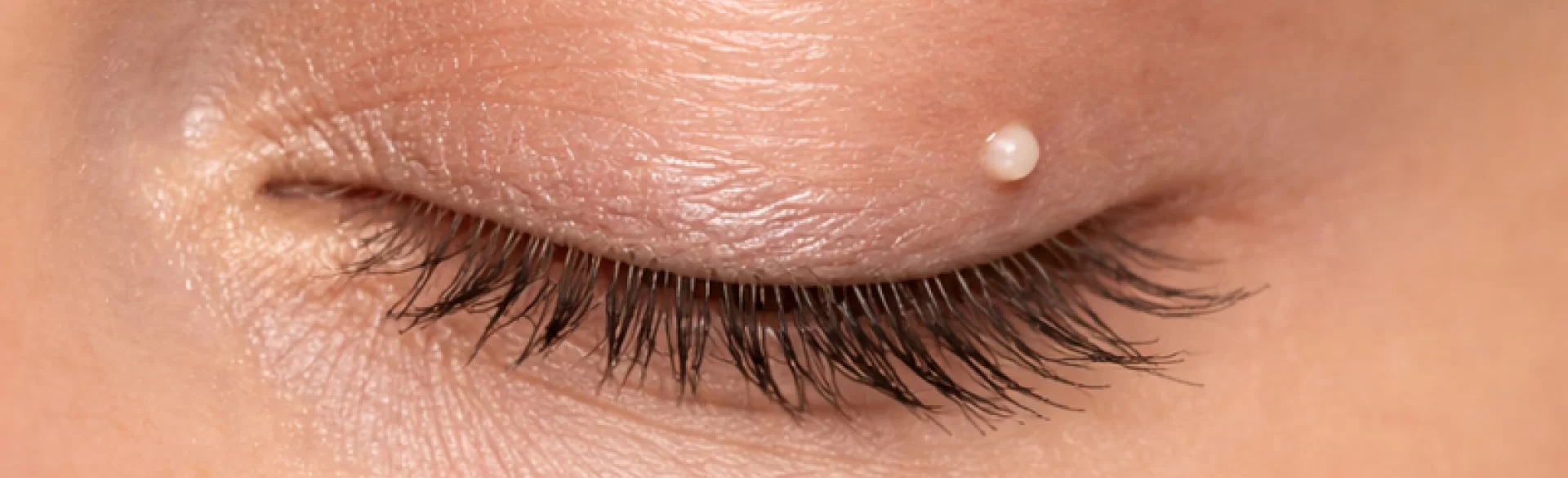 Prosak on the eyelid