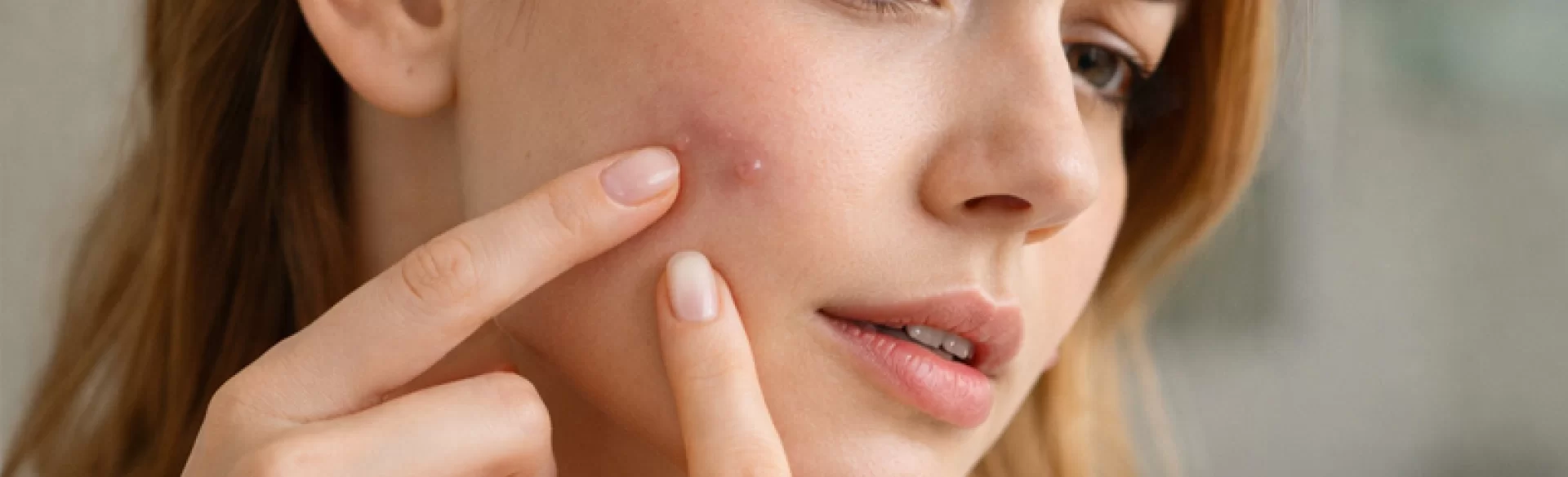 Acne – subcutaneous nodules