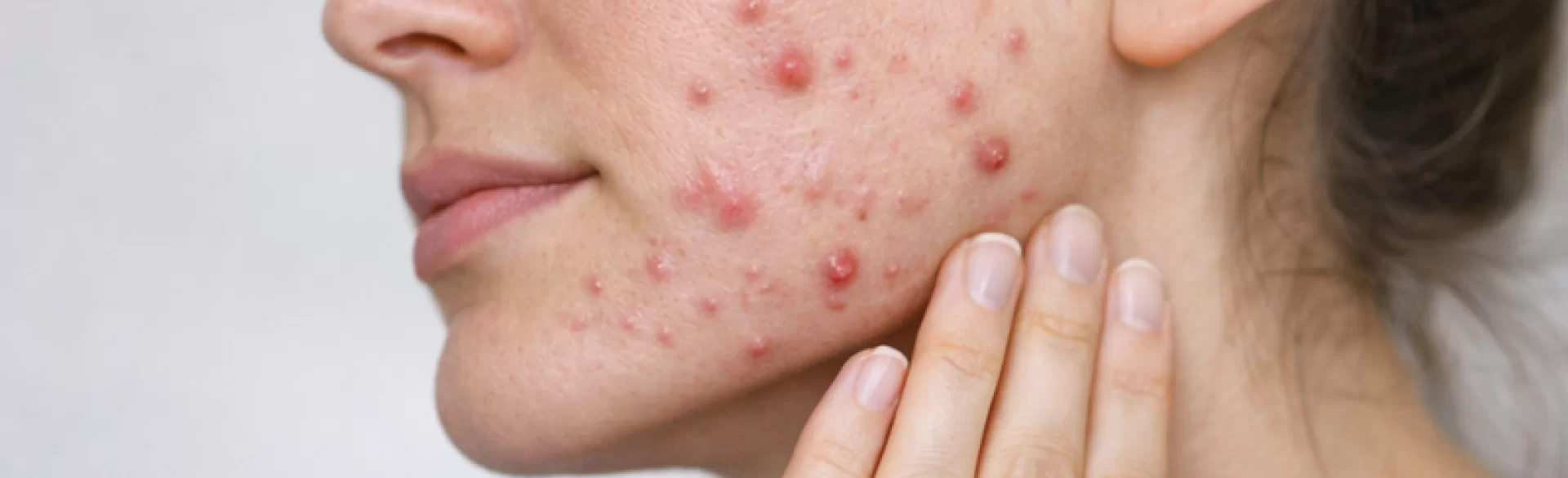 Cystic acne