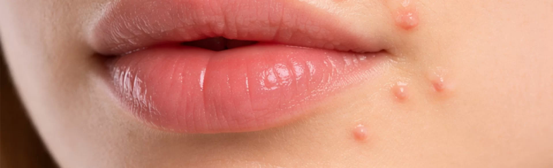 Pimples around the mouth