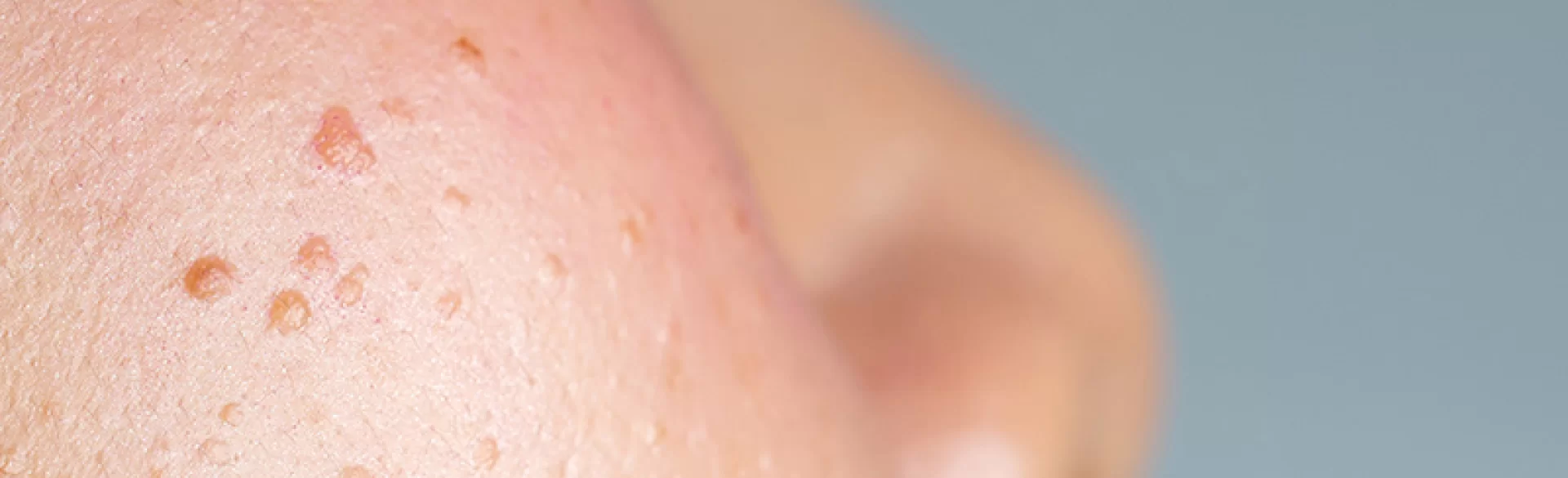 Seborrheic pimples