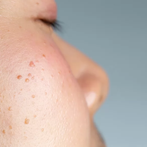 Seborrheic pimples