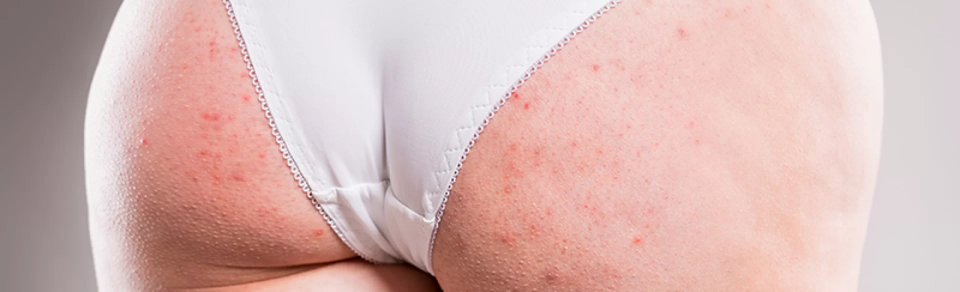 Pimples between buttocks