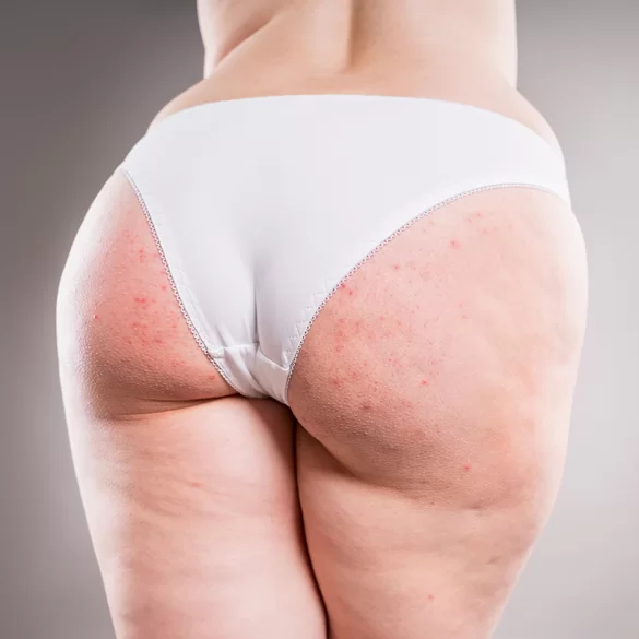 Pimples between buttocks