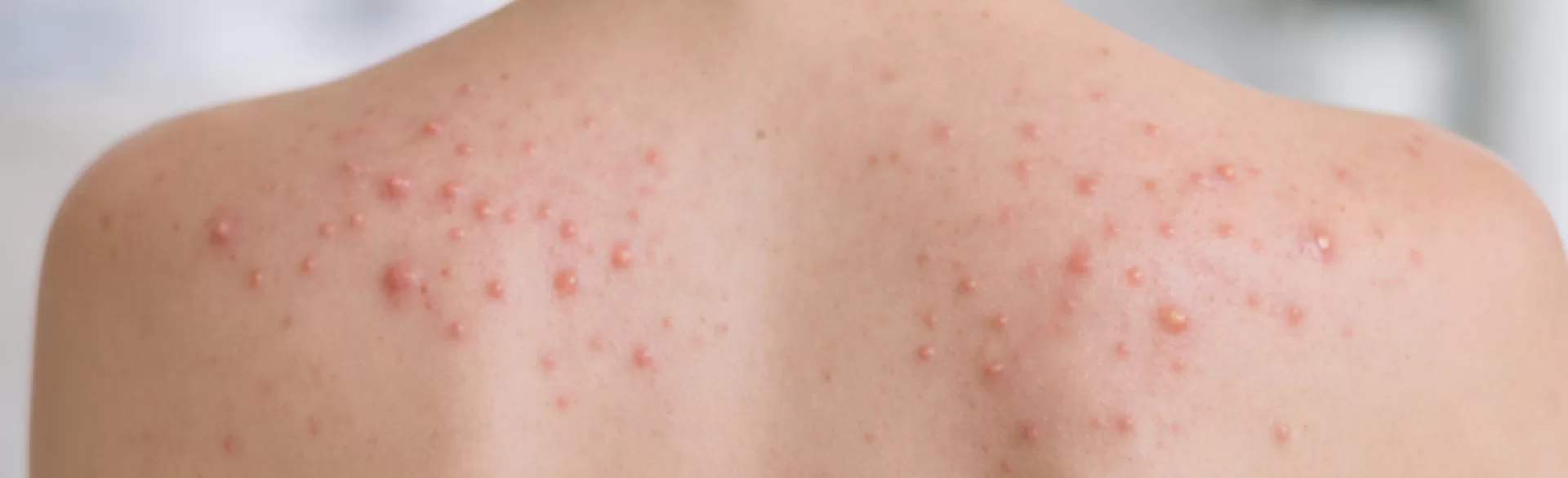 Acne on shoulder blades