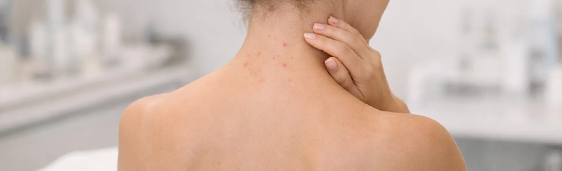 Acne on the back of the neck