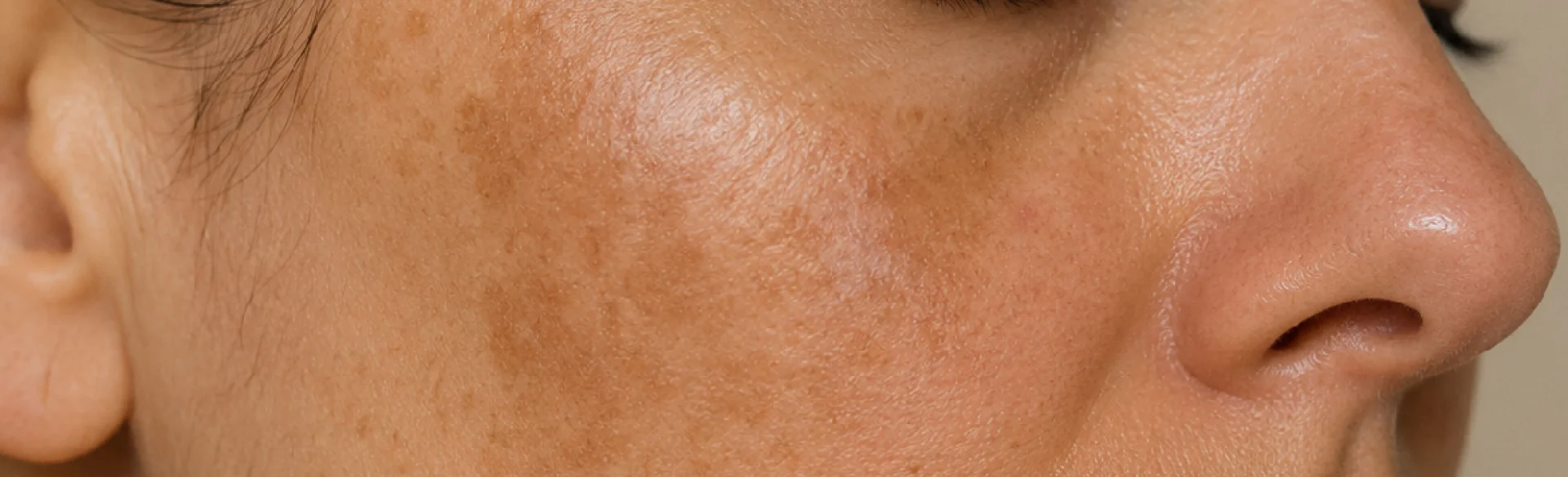 Hormonal discoloration