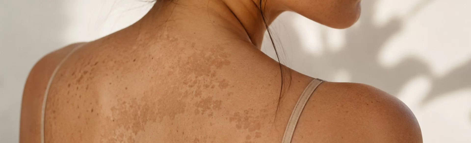 Discolorations on the body