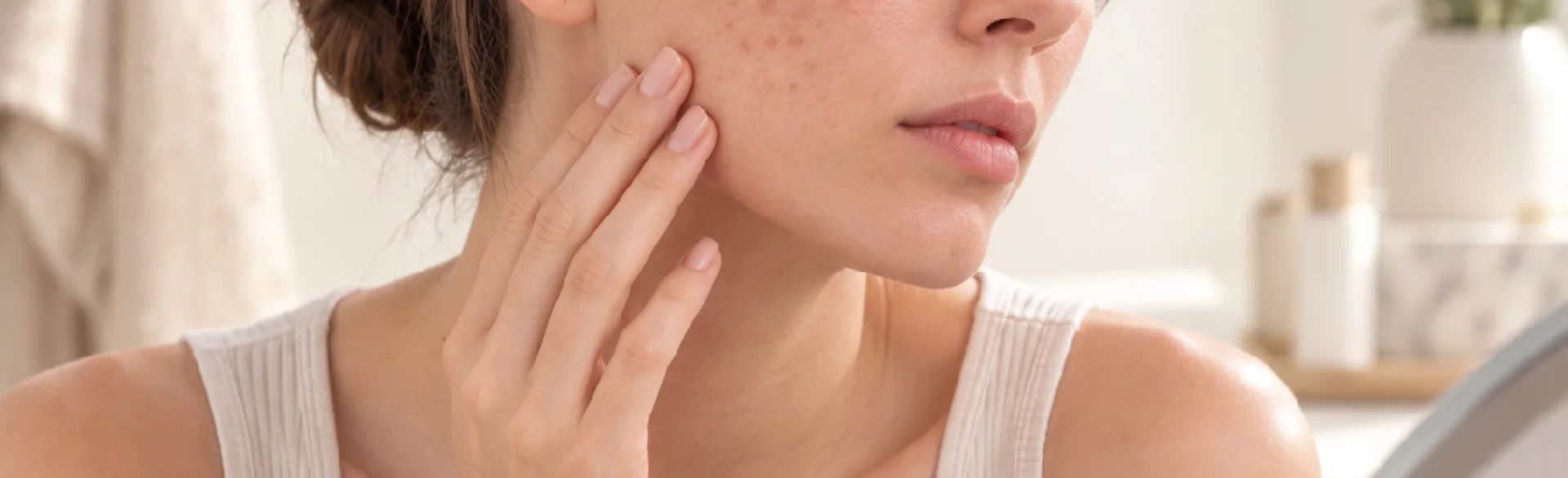 Post-acne discoloration