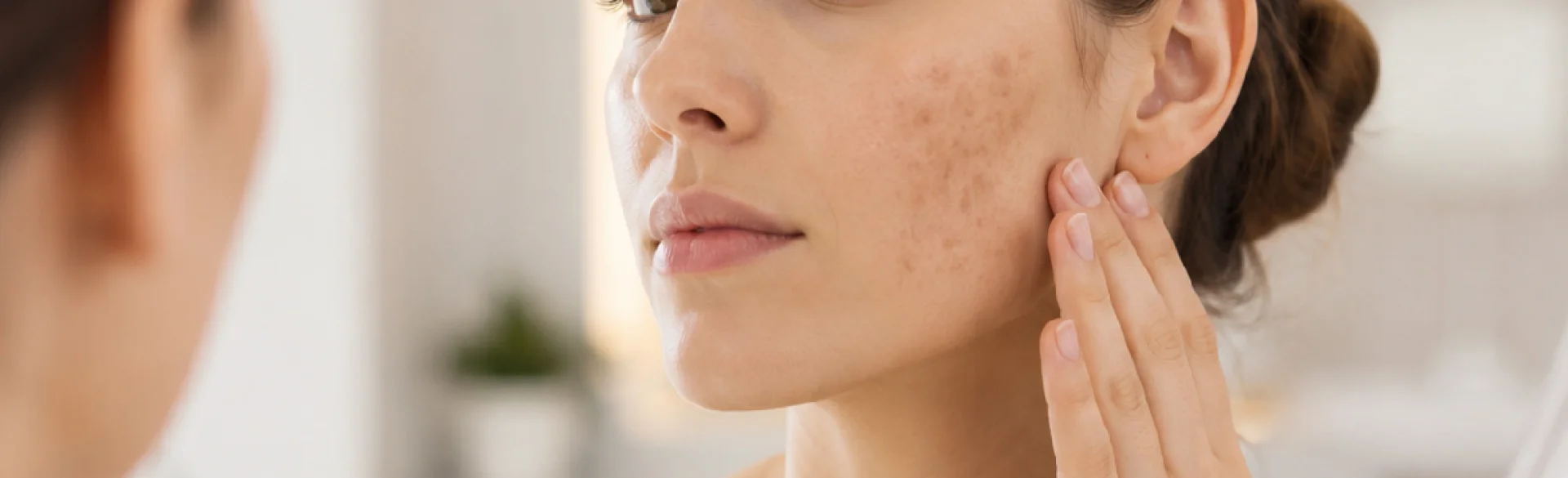 Post-inflammatory hyperpigmentation