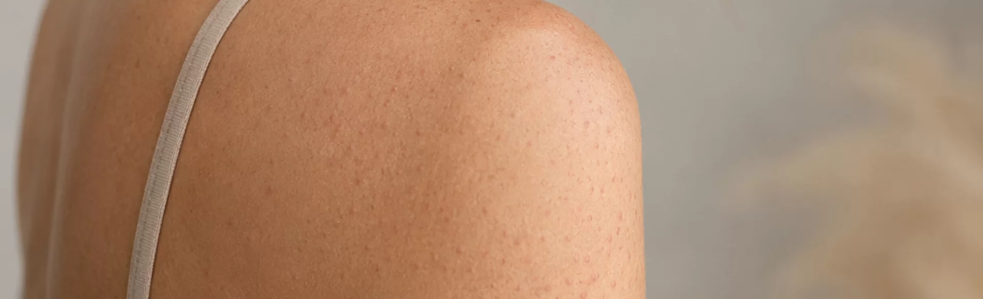 Keratosis pilaris