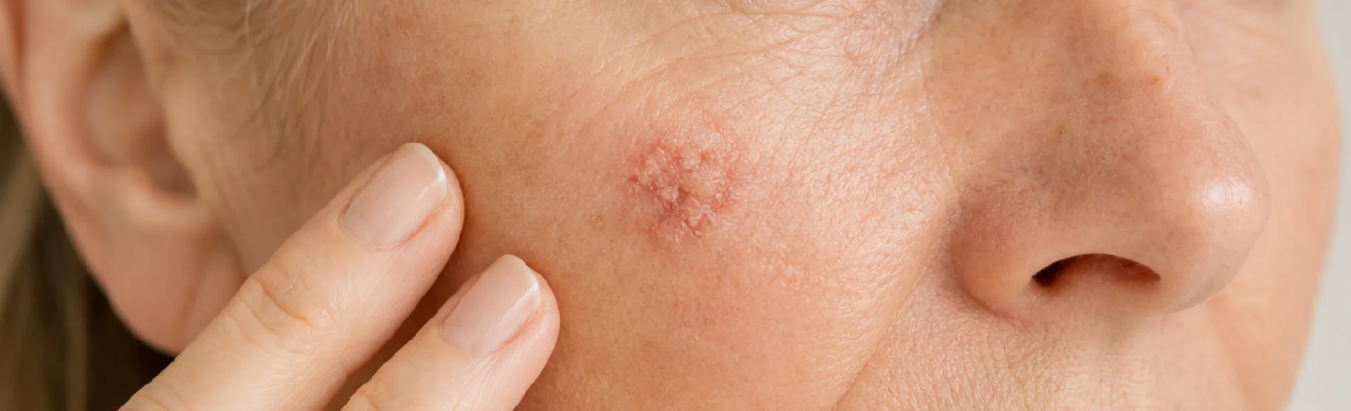 Actinic keratosis