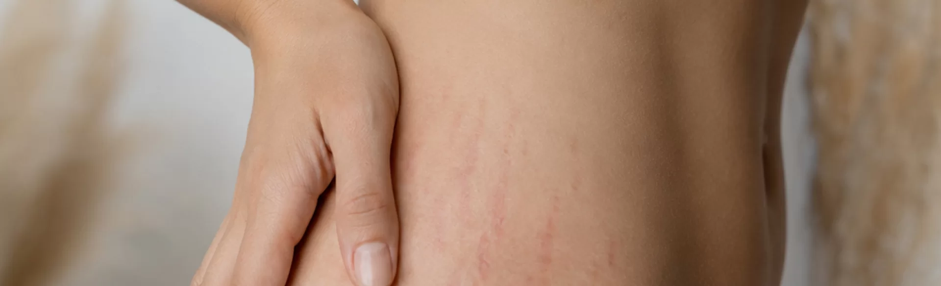 Red stretch marks