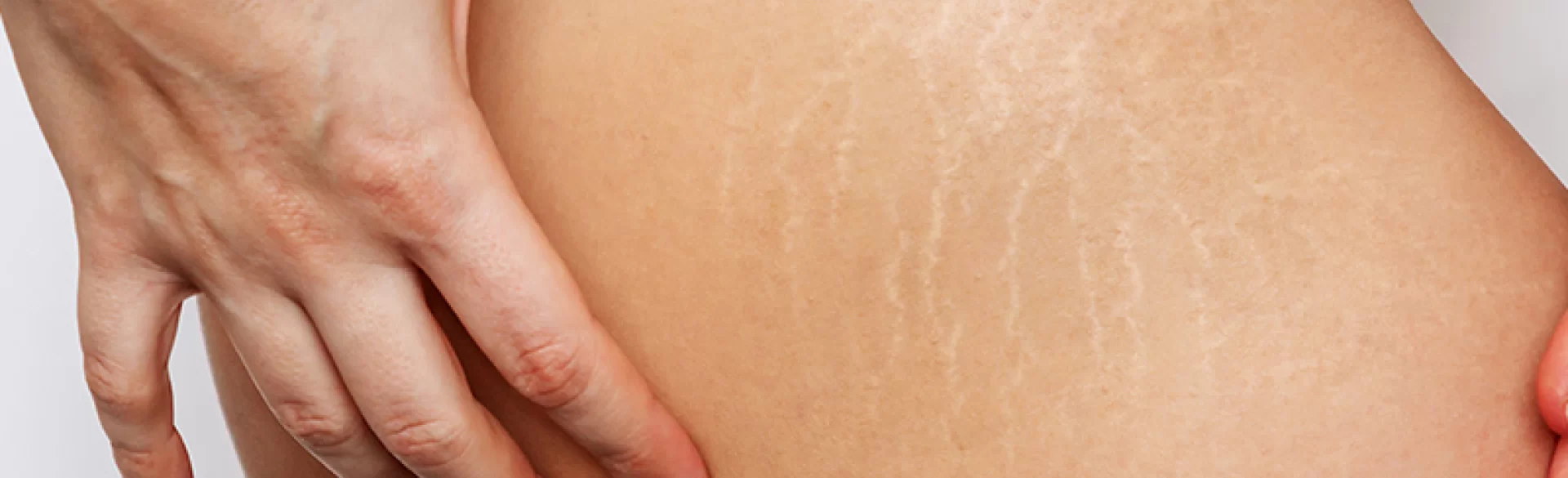 Stretch marks on thighs