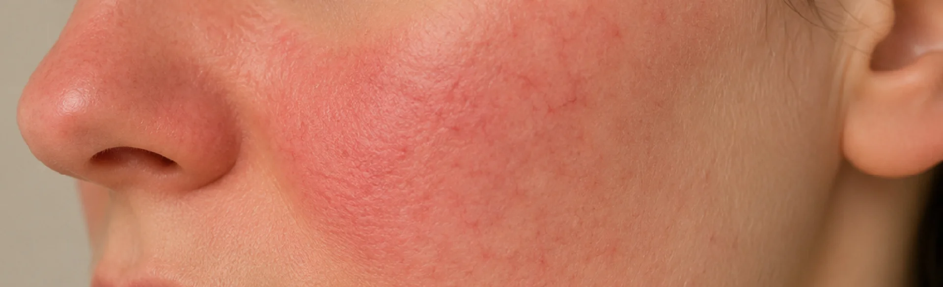 Facial redness
