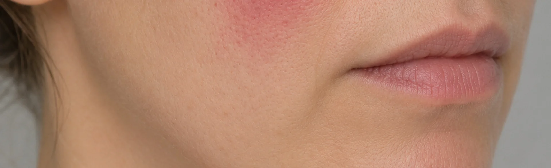 Erythema induratum