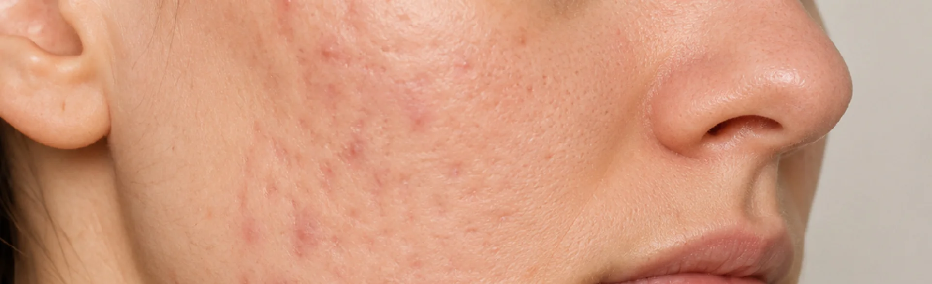 Scarring acne