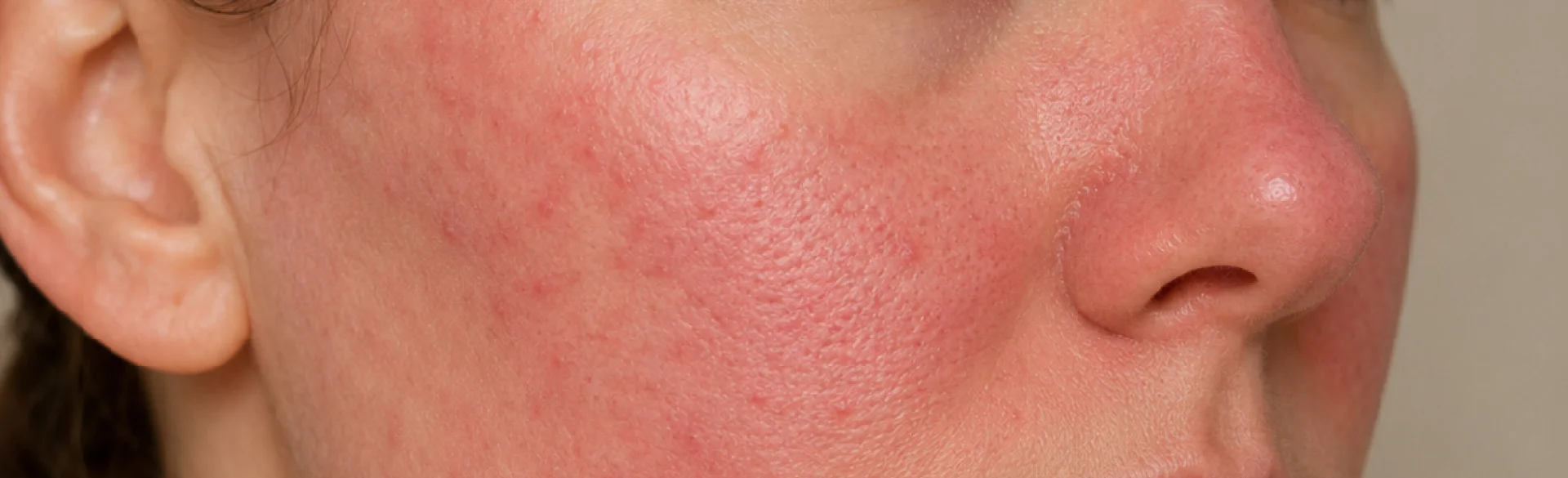 Rosacea (rosacea)