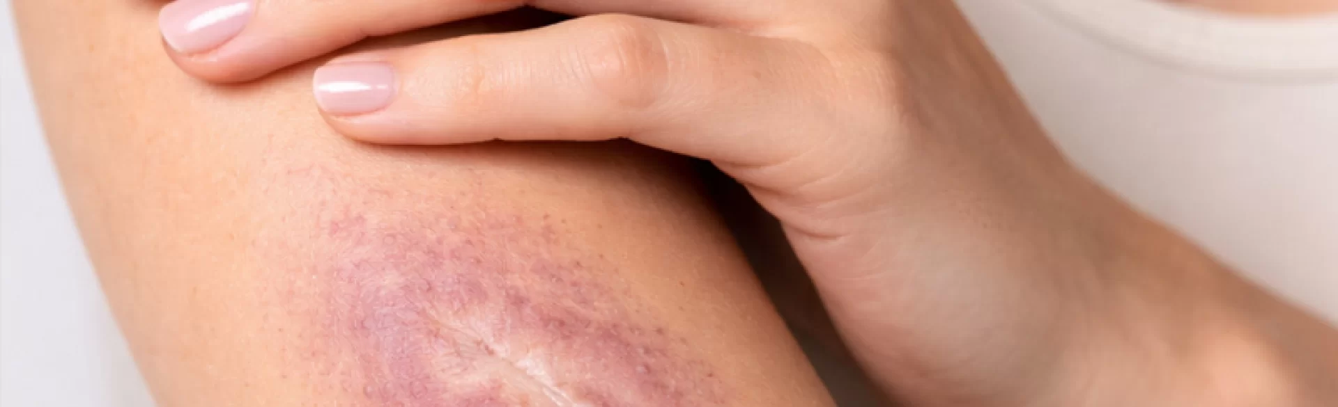 Localized scleroderma