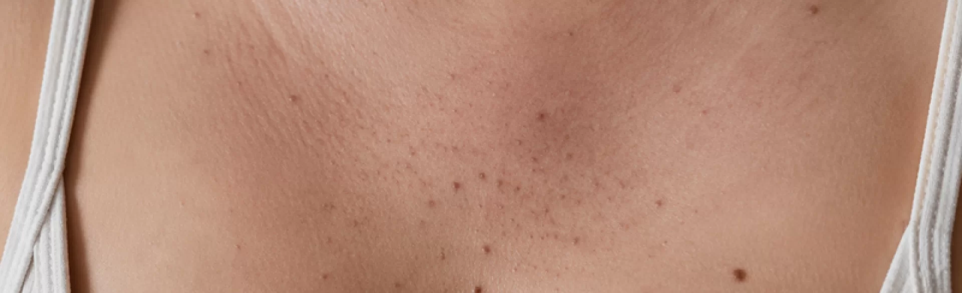 Blackheads between the breasts
